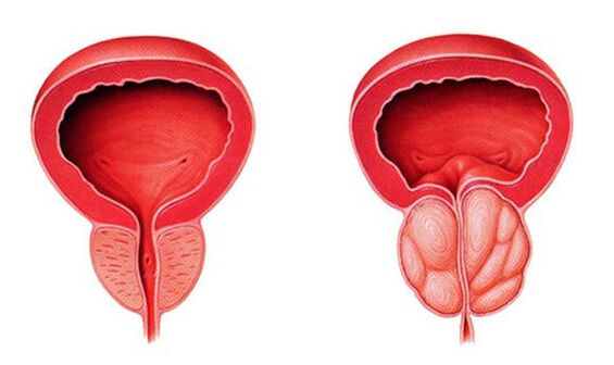Normalna i stan zapalny prostaty (zapalenie gruczołu krokowego)