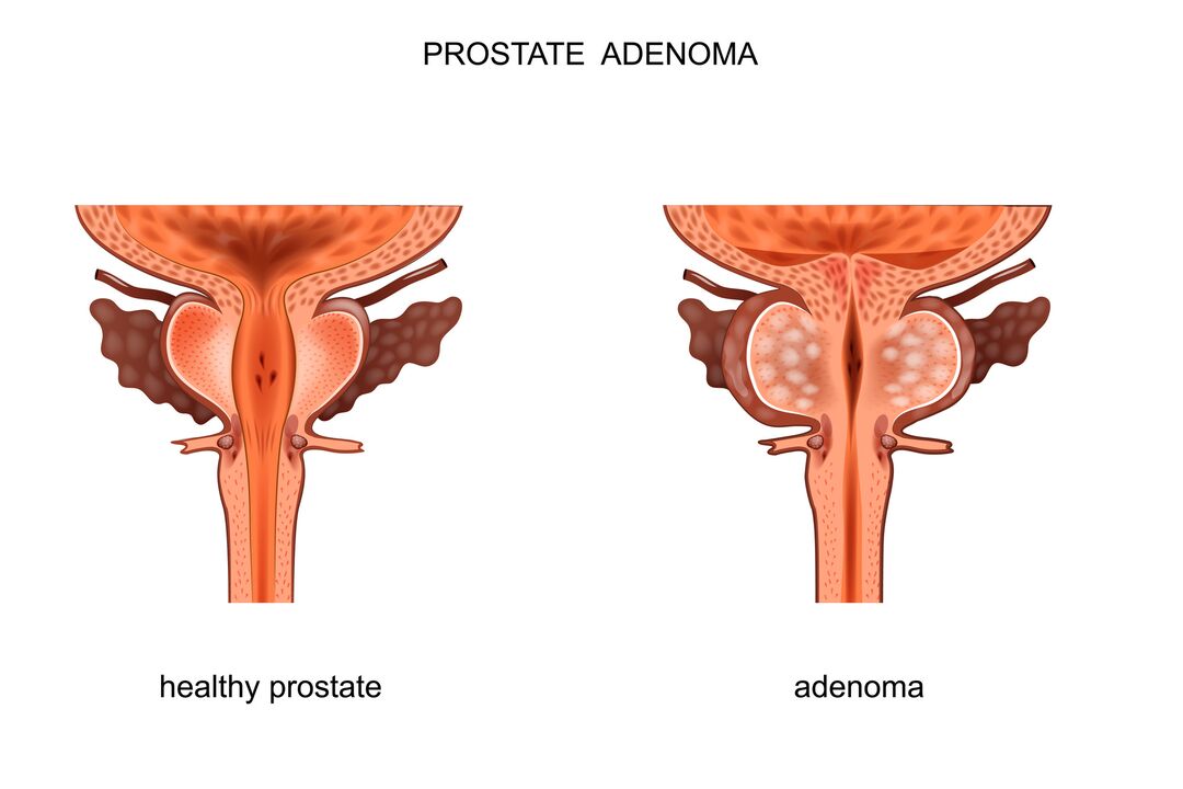 Zdrowa prostata i gruczolak