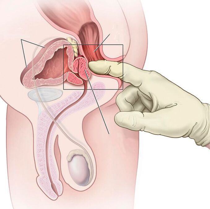 Masaż prostaty w leczeniu zapalenia gruczołu krokowego